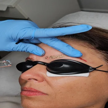Brows Laser Removal